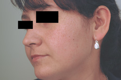 age spot removal los angeles before and after laser pictures