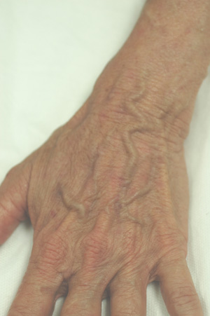 hand rejuvenation sun spots laser treatment