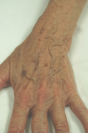 hand rejuvenation brown spots before and after pictures