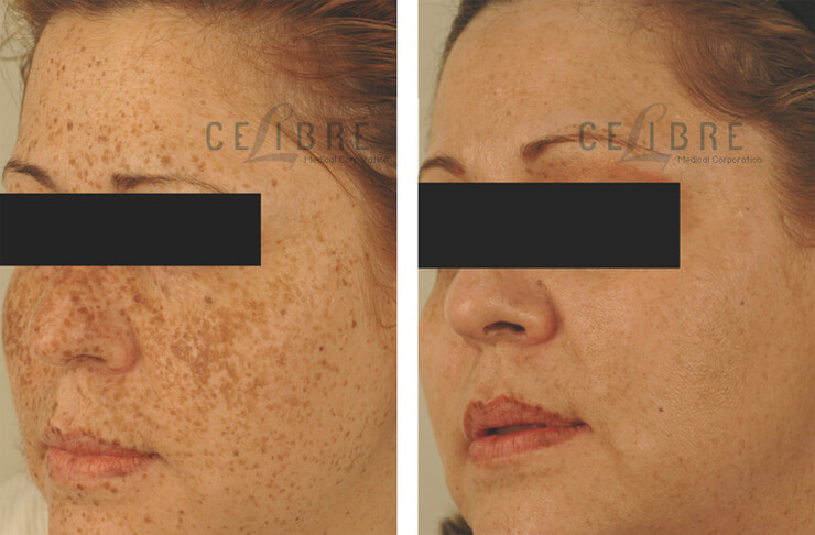 Complete Guide to Freckle Removal with Laser