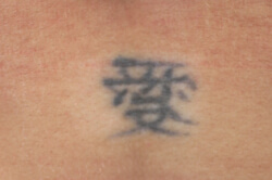 laser tattoo removal los angeles before picture