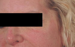 los angeles perlane injections for temples before and after pictures