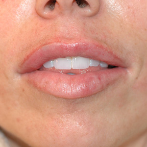 uneven lips after restylane