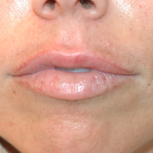 uneven lips restylane juvederm before fix asymmetrical injections symmetrical celibre