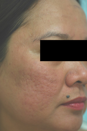 los angeles acne scar removal laser resurfacing before and after pictures