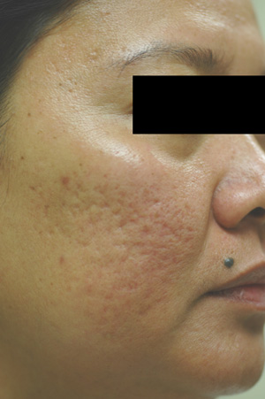 los angeles acne scar removal laser resurfacing before and after pictures