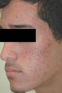 Is There Downtime with Acne Laser Treatments?