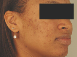 los angeles laser acne treatment before and after pictures