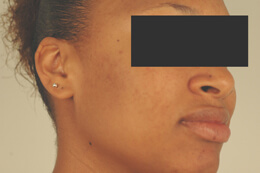 los angeles laser acne treatment before and after pictures