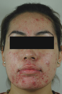 blue light treatment for acne before picture