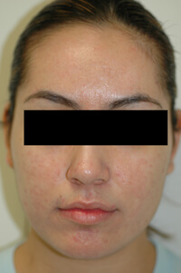 blue light treatment for acne after picture