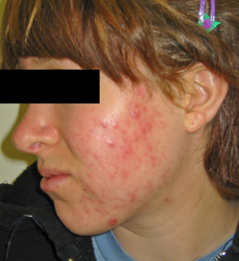 oral birth control for acne before and after pictures