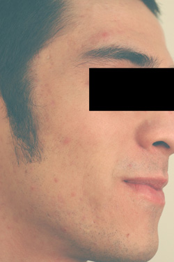 laser acne treatments after picture los angeles