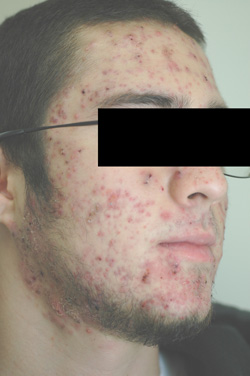 laser acne treatments before and after pictures los angeles