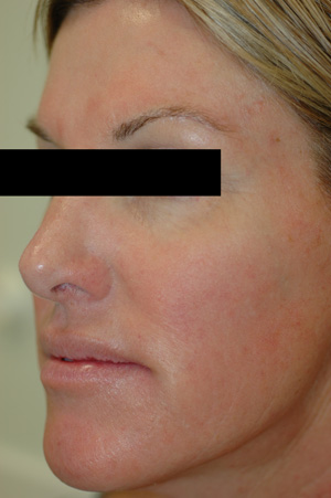 irritation acne rosacea after pictures