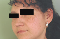 Age Spots Laser Treatments before and after pictures