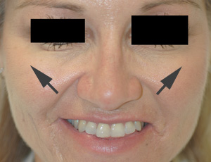 anaheim botox injections before and after pictures