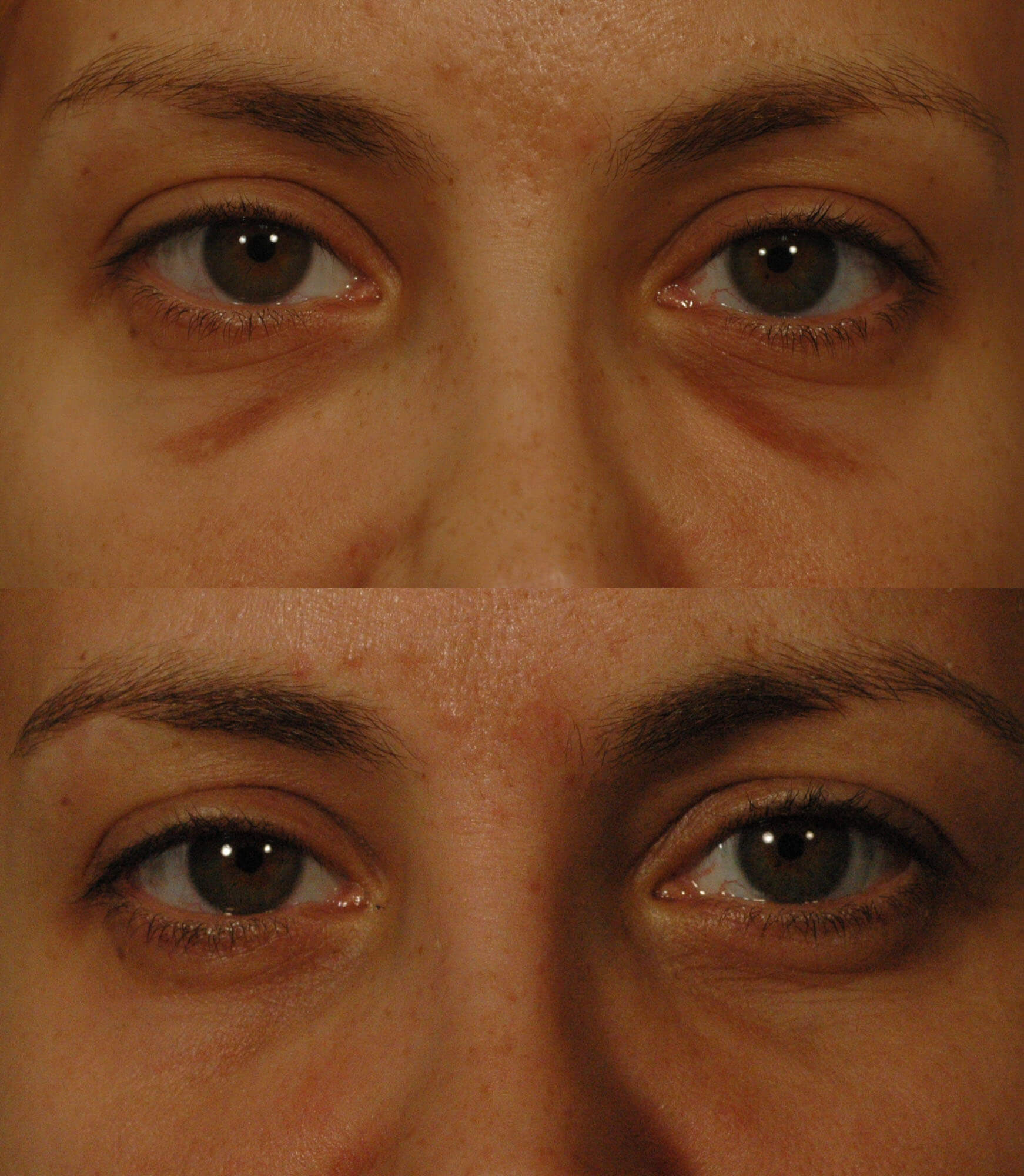 Hemosiderin Staining Before and After Photo