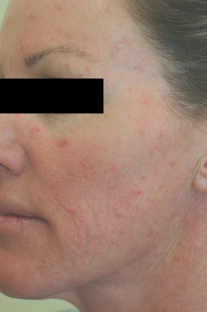 irritation acne rosacea before pictures