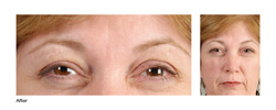 Is Botox Really Safe? Botox Los Angeles before picture