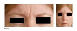 Is Botox Really Safe? Botox Los Angeles before picture