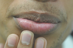 dark patch above upper lip