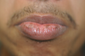 brown spots on lips laser treatment before pictures