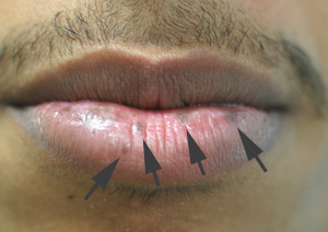 brown spots on the lips laser treatments before