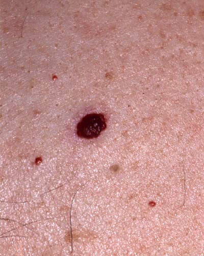 Orange County California spider hemangioma removal