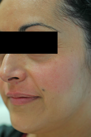 los angeles melasma after pictures