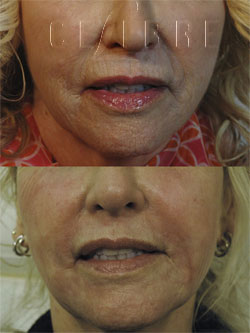 deep fractionated laser resurfacing