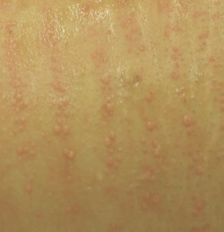red bumps after laser hair removal