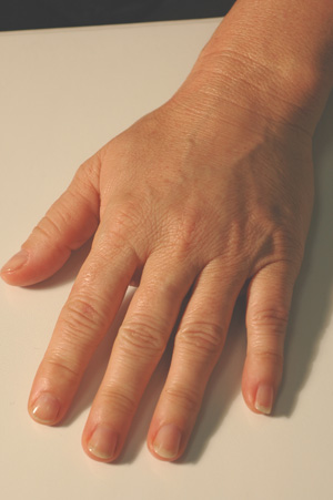 hand rejuvenation before and after pictures juvederm