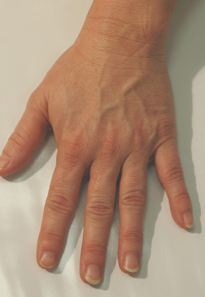 hand rejuvenation before and after pictures juvederm