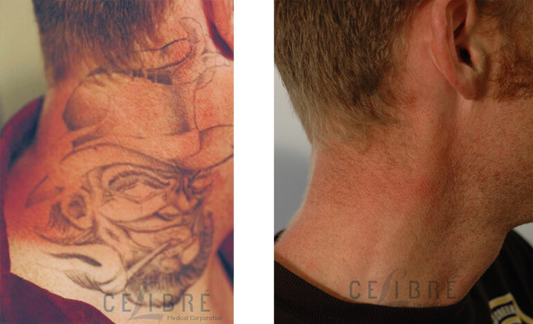 How Does Laser Tattoo Removal Work Beneath The Skin? | Fresh Skin Canvas