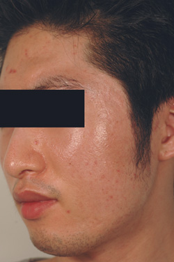 large pores los angeles before and after pictures
