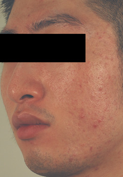 large pores los angeles before and after pictures