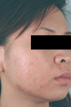 orange county california acne laser treatments before and after photos