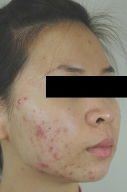 orange county california acne laser treatments before and after photos