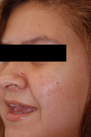 carson california laser resurfacing after pictures