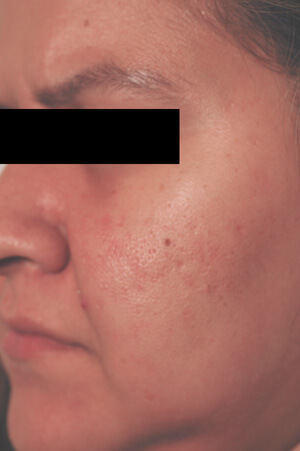 carson california laser resurfacing before pictures