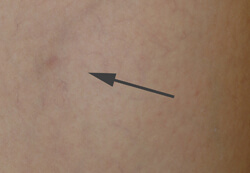 long beach spider vein removal lasers before and after pictures