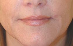 los angeles botox for smoker's lines before and after pictures