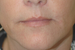 restylane or perlane before and after pictures