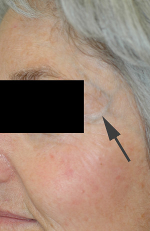 los angeles liver spot removal before and after pictures