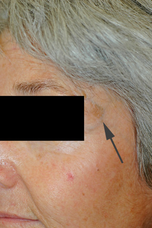 los angeles liver spot removal before and after pictures