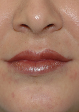 Before & After Dermal Fillers lips