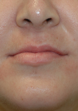 Before & After Dermal Fillers lips