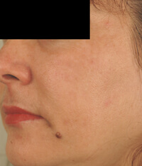 what causes melasma before and after photos