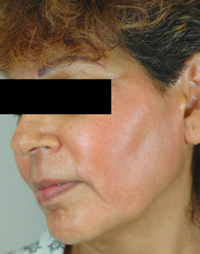 sun spots and melasma before and after photos los angeles